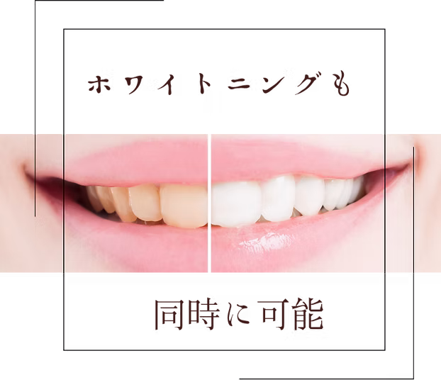 マウスピース矯正アクアシステム 施術例2｜白く美しい歯並び（WhiteBerry新潟）
